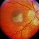 Nevus With CNVM Nevus With CNVM