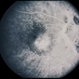 Nevus With CNVM Nevus With CNVM