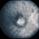 Nevus With CNVM Nevus With CNVM