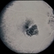 Nevus With CNVM Nevus With CNVM