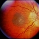 Nevus With CNVM Nevus With CNVM