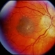 Nevus With CNVM Nevus With CNVM