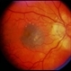 Nevus With CNVM Nevus With CNVM