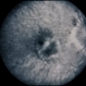 Nevus With CNVM Nevus With CNVM