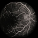 Diabetic Maculopathy  Multiple Myeloma with Retinal Detachment Diabetic Maculopathy  Multiple Myeloma with Retinal Detachment