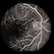 Diabetic Maculopathy  Multiple Myeloma with Retinal Detachment Diabetic Maculopathy  Multiple Myeloma with Retinal Detachment