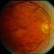 Diabetic Maculopathy  Multiple Myeloma with Retinal Detachment Diabetic Maculopathy  Multiple Myeloma with Retinal Detachment