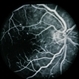 Diabetic Maculopathy  Multiple Myeloma with Retinal Detachment Diabetic Maculopathy  Multiple Myeloma with Retinal Detachment