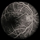 Diabetic Maculopathy  Multiple Myeloma with Retinal Detachment Diabetic Maculopathy  Multiple Myeloma with Retinal Detachment