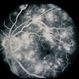 Diabetic Maculopathy  Multiple Myeloma with Retinal Detachment Diabetic Maculopathy  Multiple Myeloma with Retinal Detachment