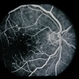 Diabetic Maculopathy  Multiple Myeloma with Retinal Detachment Diabetic Maculopathy  Multiple Myeloma with Retinal Detachment