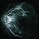 Diabetic Maculopathy  Multiple Myeloma with Retinal Detachment Diabetic Maculopathy  Multiple Myeloma with Retinal Detachment