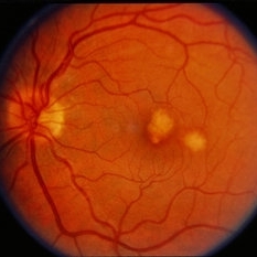 Presumed Ocular Histoplasmosis Syndrome with Choroidal Neovascular ...