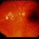 CMV Retinitis CMV Retinitis