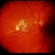 CMV Retinitis CMV Retinitis