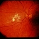 CMV Retinitis CMV Retinitis