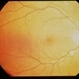 CMV Retinitis CMV Retinitis