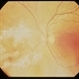CMV Retinitis CMV Retinitis