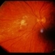 CMV Retinitis CMV Retinitis