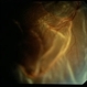 Systemic Lupus Erythematosys with Retinal Detachment Systemic Lupus Erythematosys with Retinal Detachment