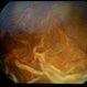Systemic Lupus Erythematosys with Retinal Detachment Systemic Lupus Erythematosys with Retinal Detachment