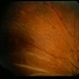 Systemic Lupus Erythematosys with Retinal Detachment Systemic Lupus Erythematosys with Retinal Detachment