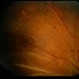 Systemic Lupus Erythematosys with Retinal Detachment Systemic Lupus Erythematosys with Retinal Detachment