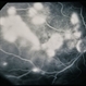 Systemic Lupus Erythematosys with Retinal Detachment Systemic Lupus Erythematosys with Retinal Detachment