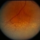 Systemic Lupus Erythematosys with Retinal Detachment Systemic Lupus Erythematosys with Retinal Detachment
