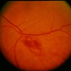 BRVO with Macular Exudate - Retina Image Bank