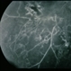 BRVO - Massive Exudate from Collaterals BRVO - Massive Exudate from Collaterals