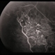 BRVO - Massive Exudate from Collaterals BRVO - Massive Exudate from Collaterals