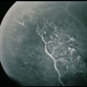 BRVO - Massive Exudate from Collaterals BRVO - Massive Exudate from Collaterals