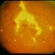 BRVO - Massive Exudate from Collaterals BRVO - Massive Exudate from Collaterals