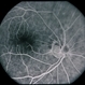 Myopic With CNVM / Enlarging Scar