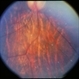 Unusual Tapetoretinal Degeneration Unusual Tapetoretinal Degeneration