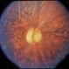 Unusual Tapetoretinal Degeneration Unusual Tapetoretinal Degeneration