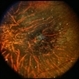 Unusual Tapetoretinal Degeneration Unusual Tapetoretinal Degeneration
