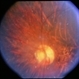 Unusual Tapetoretinal Degeneration Unusual Tapetoretinal Degeneration