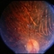 Unusual Tapetoretinal Degeneration Unusual Tapetoretinal Degeneration