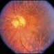 Unusual Tapetoretinal Degeneration Unusual Tapetoretinal Degeneration