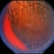 Unusual Tapetoretinal Degeneration Unusual Tapetoretinal Degeneration