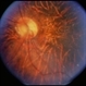 Unusual Tapetoretinal Degeneration Unusual Tapetoretinal Degeneration