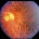 Unusual Tapetoretinal Degeneration Unusual Tapetoretinal Degeneration