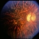 Unusual Tapetoretinal Degeneration Unusual Tapetoretinal Degeneration