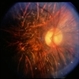 Unusual Tapetoretinal Degeneration Unusual Tapetoretinal Degeneration