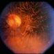 Unusual Tapetoretinal Degeneration Unusual Tapetoretinal Degeneration