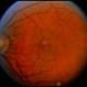 BRVO / Pseudo Macroaneurysm
