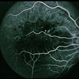 BRVO / Pseudo Macroaneurysm