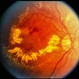 BRVO / Pseudo Macroaneurysm